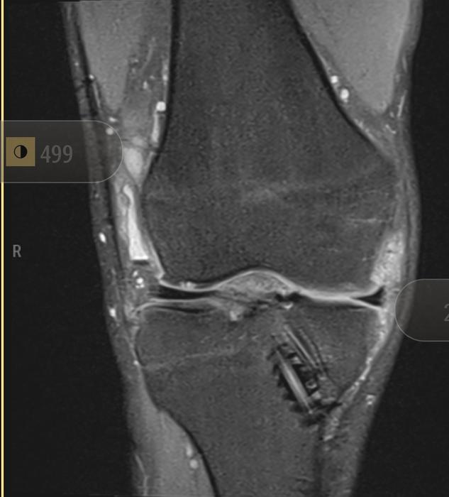 MRI of the knee from the front