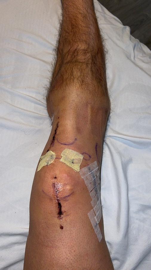 The knee with fresh surgical incisions and tape
